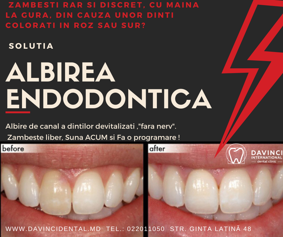 zambesti rar si discret cu maina la gura din cauza dintilor roz sau suri? solutia albirea endodontica pentru dintii devitalizati, fara nerv
